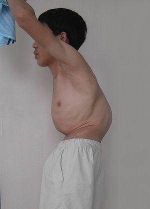 强直性脊柱炎要孩子会遗传吗 强直性脊柱炎要孩子会遗传吗