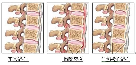 强直性脊柱炎的诊断标准 强直性脊柱炎的诊断标准
