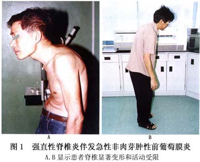 强直性脊柱炎会误诊的原因 强直性脊柱炎会误诊的原因