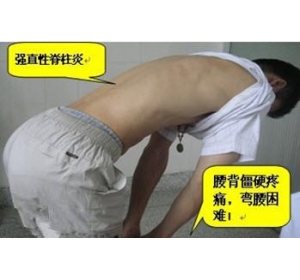 强直性脊柱炎是怎么来的 强直性脊柱炎是怎么来的