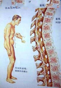 临床上强直性脊柱炎应如何检查 临床上强直性脊柱炎应如何检查