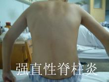 强直性脊柱炎会有怎样的危害 强直性脊柱炎会有怎样的危害
