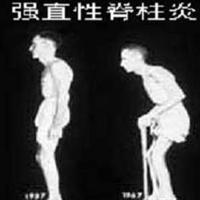 诊断强直性脊柱炎有怎样的方法 诊断强直性脊柱炎有怎样的方法