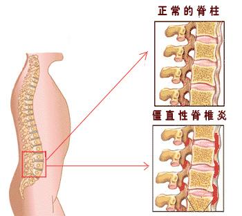 强直性脊柱炎都会损坏哪些关节 强直性脊柱炎都会损坏哪些关节