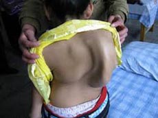 从哪些方面能体现强直性脊柱炎 从哪些方面能体现强直性脊柱炎