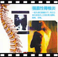 强直性脊柱炎的危害都危及到哪些方面 强直性脊柱炎的危害都危及到哪些方面