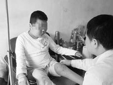 如何控制早期强制性脊柱炎的病情 如何控制早期强制性脊柱炎的病情