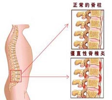 强直性脊柱炎的发病原因是哪些 强直性脊柱炎的发病原因是哪些