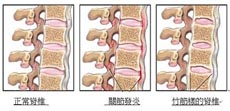 强直性脊柱炎患者需要检查哪些方面 强直性脊柱炎患者需要检查哪些方面