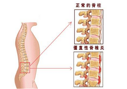 怎样才能正确诊断强直性脊柱炎 怎样才能正确诊断强直性脊柱炎
