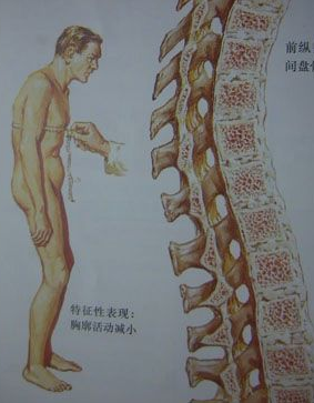 如何做好强直性脊柱炎患者的护理 如何做好强直性脊柱炎患者的护理