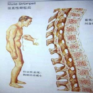 晨僵在强直性脊柱炎里面要怎样治疗 晨僵在强直性脊柱炎里面要怎样治疗