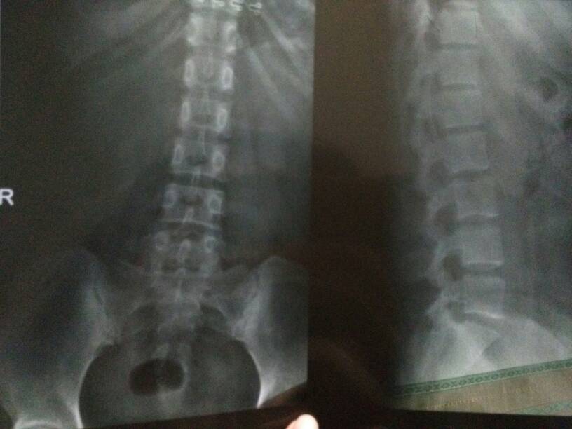 强直性脊柱炎有哪些害处呢 强直性脊柱炎有哪些害处呢