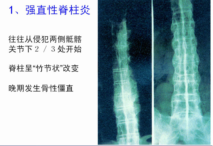 检查强直性脊柱炎都有哪些方法呢 检查强直性脊柱炎都有哪些方法呢