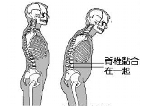如何预防强直性脊柱炎的侵袭 如何预防强直性脊柱炎的侵袭