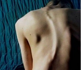女性强直性脊柱炎患者再初期会有什么症状 女性强直性脊柱炎患者再初期会有什么症状