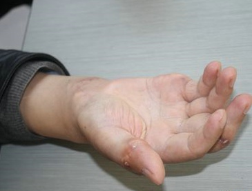 “帝王病”-痛风 青睐白领男 “帝王病”-痛风 青睐白领男