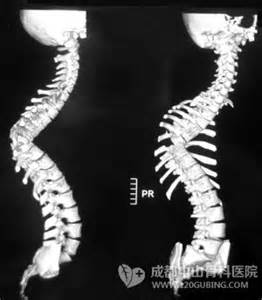 强直性脊柱炎做什么检查啊 强直性脊柱炎做什么检查啊