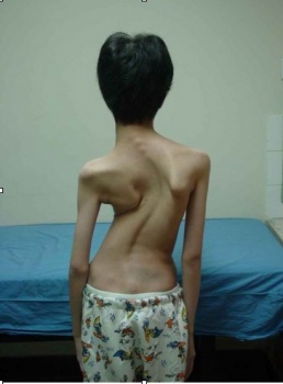强直性脊柱炎有什么特征 强直性脊柱炎有什么特征