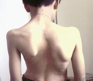 强直性脊柱炎怎么确诊? 强直性脊柱炎怎么确诊?