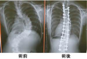 强直性脊柱炎如何锻炼? 强直性脊柱炎如何锻炼?