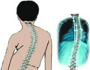 强直性脊柱炎对女性有多大影响