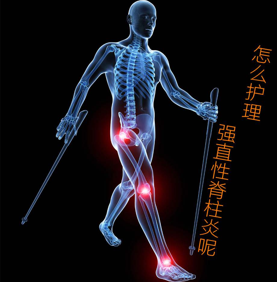 患上了强直性脊柱炎 我们如何护理比较好 患上了强直性脊柱炎 我们如何护理比较好