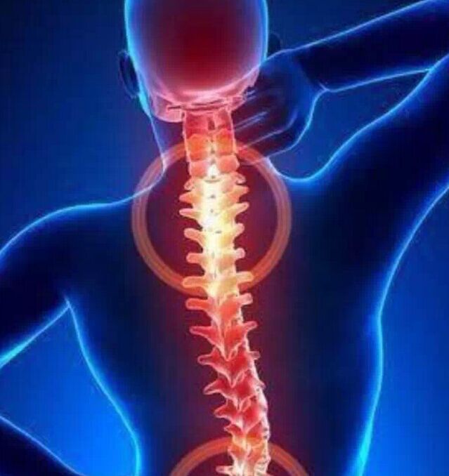 腰痛也是强制性脊柱炎的症状