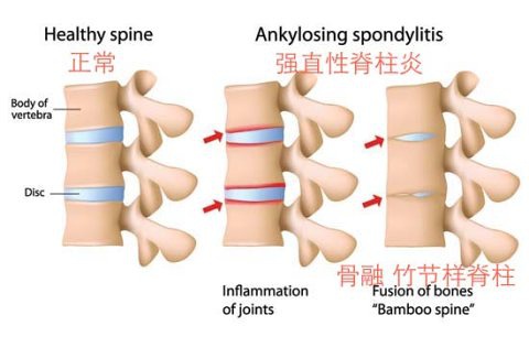 强直性脊柱炎怎样做好自我的全方位护理