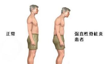 得了强直性脊柱炎会具体体现在哪些部位