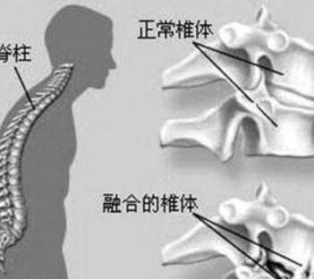 有哪些症状表明是强直性脊柱炎