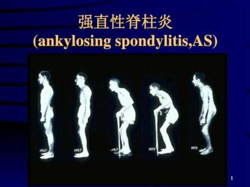 强直性脊柱炎早期症状有哪些如果出现这些情况你应该注意了
