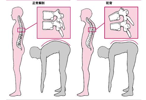 强直性脊柱炎中晚期有什么症状?郑
