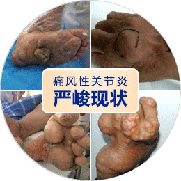 全国助残日|共抗风湿·健行中原—— 京豫三甲风湿名医多学科联合会诊暨抗复发防残治疗帮扶行动 全国助残日|共抗风湿·健行中原—— 京豫三甲风湿名医多学科联合会诊暨抗复发防残治疗帮扶行动